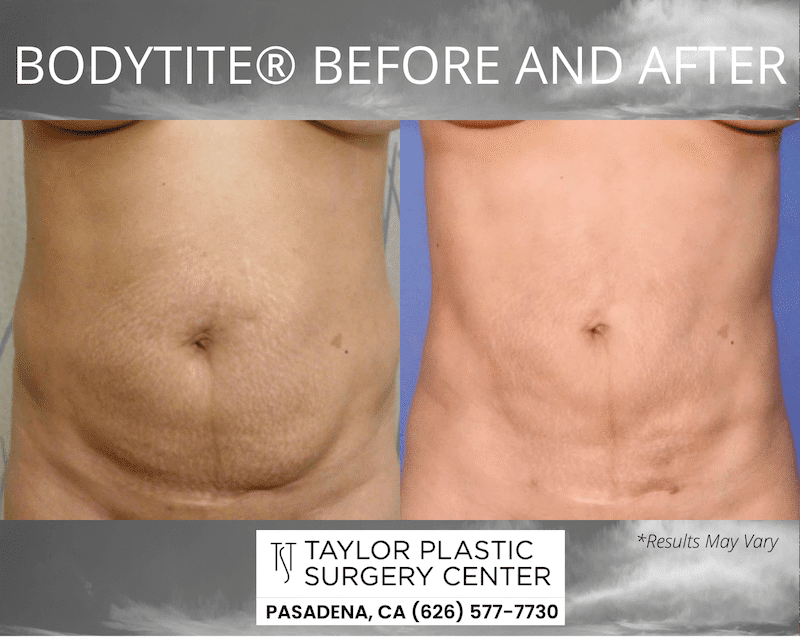 Before and after image showing the results of a BodyTite® body contouring treatment performed in Pasadena, CA.