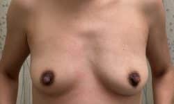 Breast Augmentation 20 Before