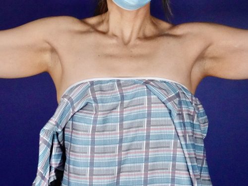 BodyTite 05 Before 1