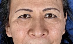 Eyelid Surgery 17 Before