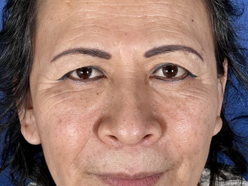 Eyelid Surgery 17 Before 1