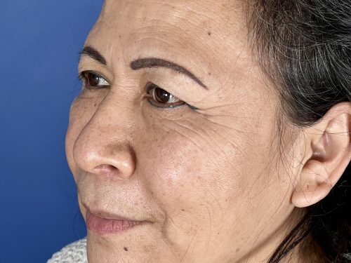 Eyelid Surgery 17 Before 2