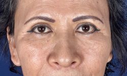 Eyelid Surgery 17 After