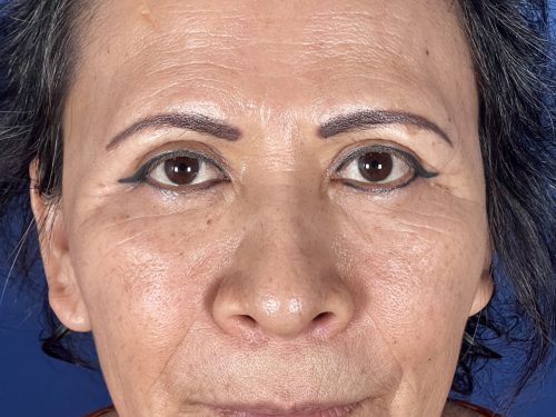 Eyelid Surgery 17 After 1