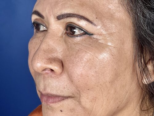 Eyelid Surgery 17 After 2