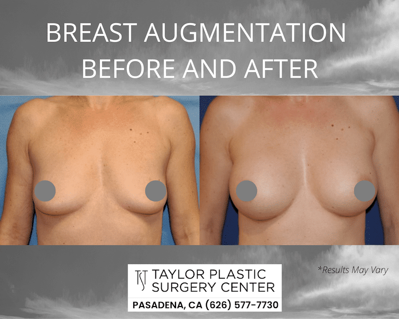 Before and after image showing the results of a breast augmentation performed in Pasadena, CA.