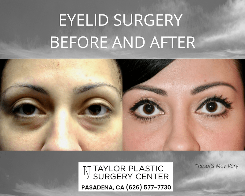 Before and after image showing the results of an eyelid surgery performed in Pasadena, CA.