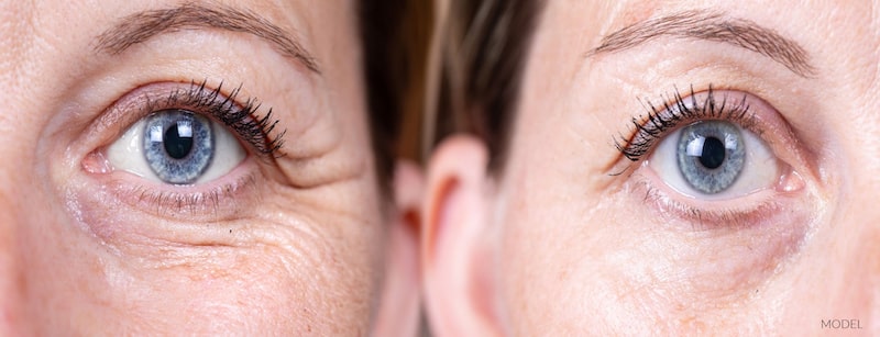 Before and after photos of eyelid surgery. Model image