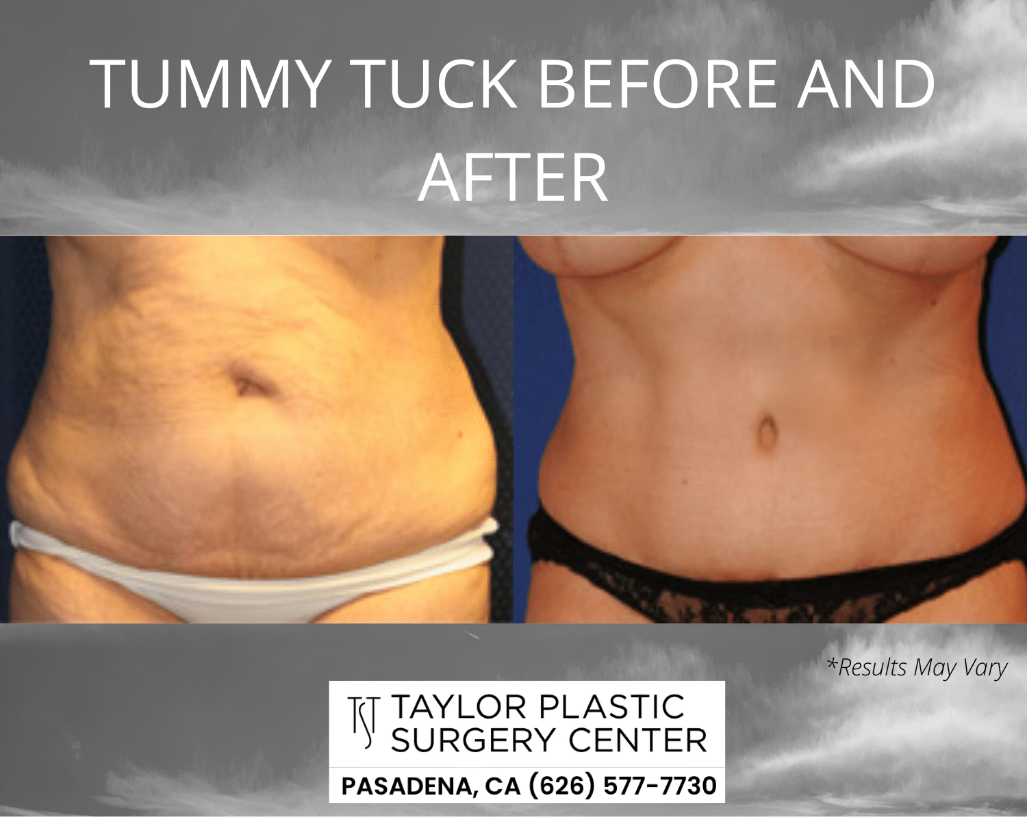 Tummy Tuck - American Academy of Cosmetic Surgery