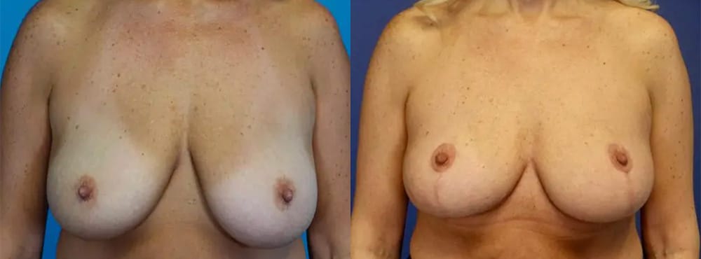 Breast Implant Removal Patient 1 Results