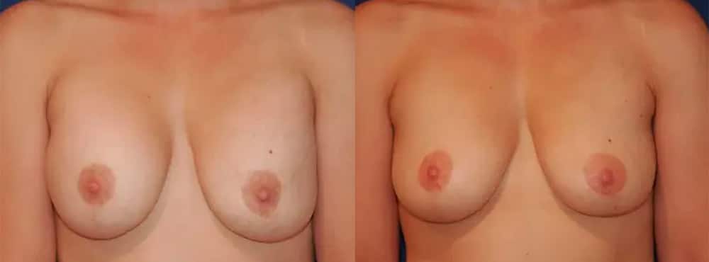 Breast Implant Removal Patient 2 Results