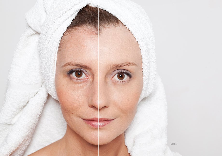 A woman wearing a white towel on her head before and after a skin tightening treatment.