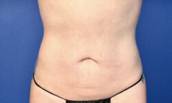 BodyTite 06 After