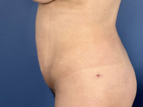 BodyTite 08 After 2