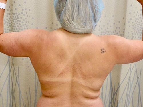 BodyTite 07 Before 1