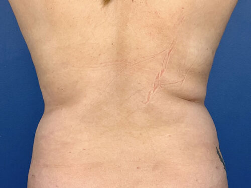 BodyTite 06 Before 2