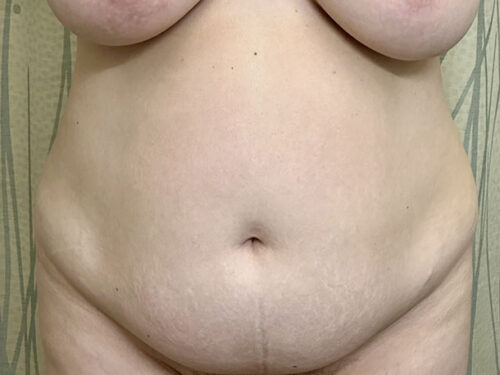 BodyTite 08 Before 1