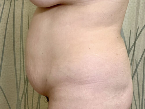 BodyTite 08 Before 2