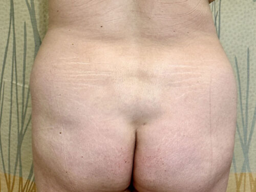 BodyTite 08 Before 3