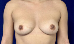 Breast Lift 08 After