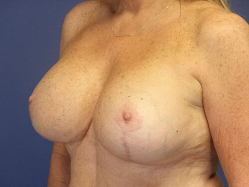 Breast Lift 09 After 3