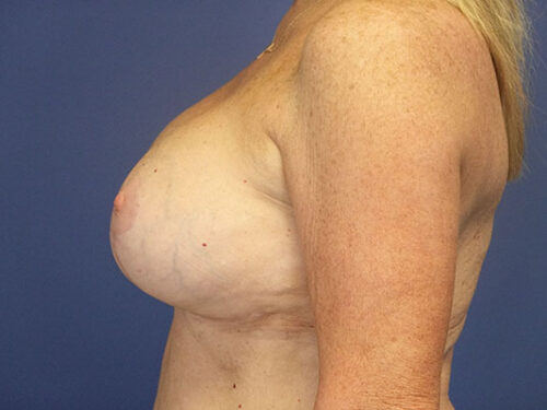 Breast Lift 09 After 2