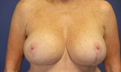 Breast Lift 09 After