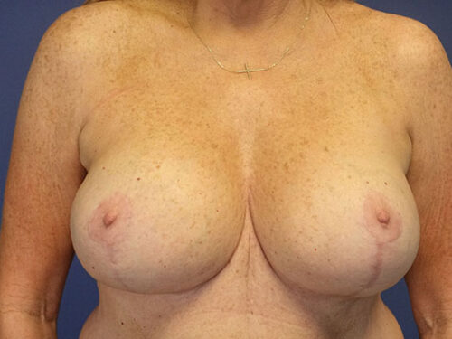 Breast Lift 09 After 1