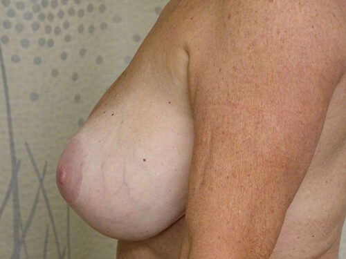 Breast Lift 09 Before 2
