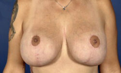 Breast Augmentation Revision 05 After