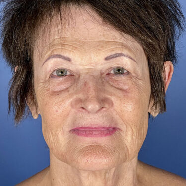 Facelift 15 Before 1