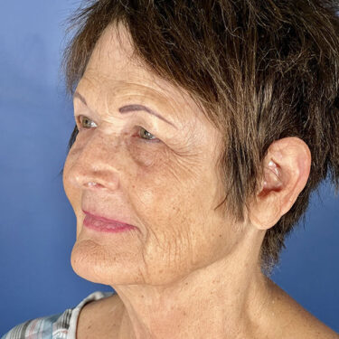 Facelift 15 Before 2