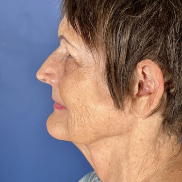 Facelift 15 Before 3