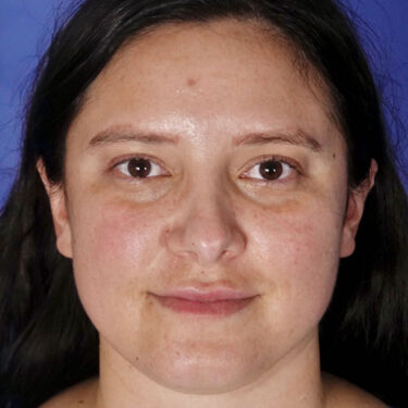 FaceTite 06 Before 1