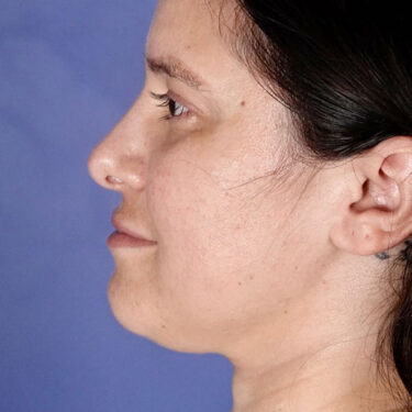 FaceTite 06 Before 2