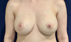 Breast Augmentation 21 After