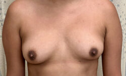 Breast Augmentation 22 Before