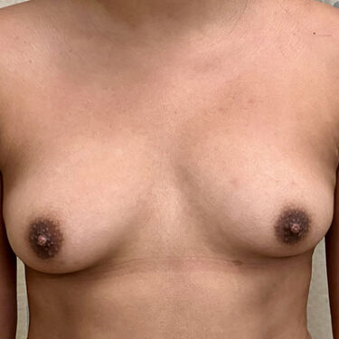 Breast Augmentation 22 Before 1