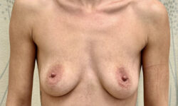 Breast Augmentation 24 Before