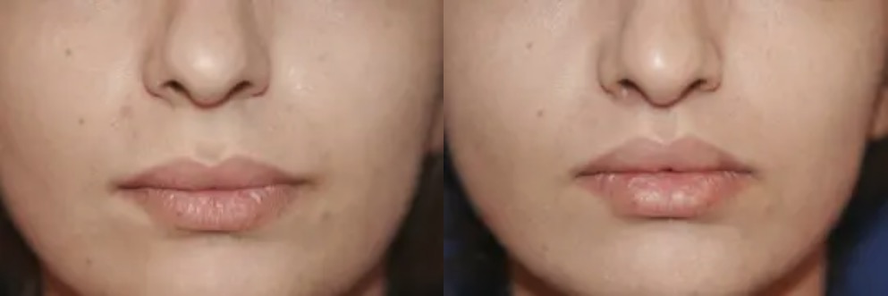 before and after lip augmentation