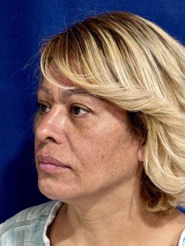 FaceTite 08 & Eyelid Surgery Before 2