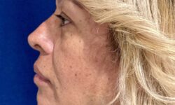 FaceTite 08 & Eyelid Surgery Before