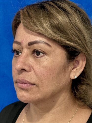 FaceTite 08 & Eyelid Surgery After 2