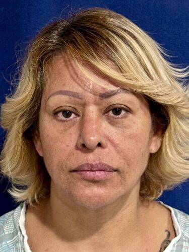 FaceTite 08 & Eyelid Surgery Before 3