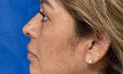 FaceTite 08 & Eyelid Surgery After