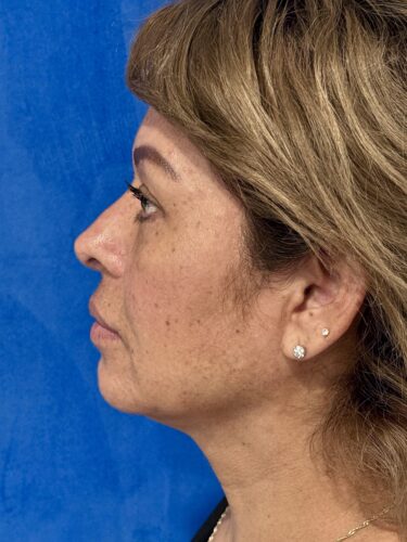 FaceTite 08 & Eyelid Surgery After 1