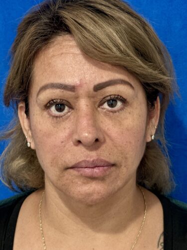 FaceTite 08 & Eyelid Surgery After 3