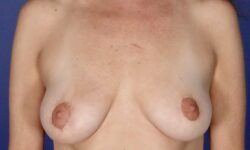 Breast Lift 10 After