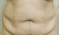 Tummy Tuck 18 Before