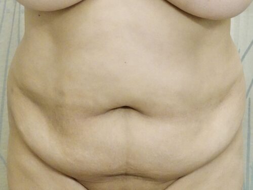 Tummy Tuck 18 Before 1